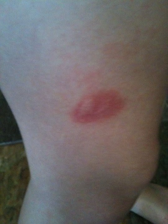 Mastocytosis A Rare Disease Mastocytosis Flare Pictures