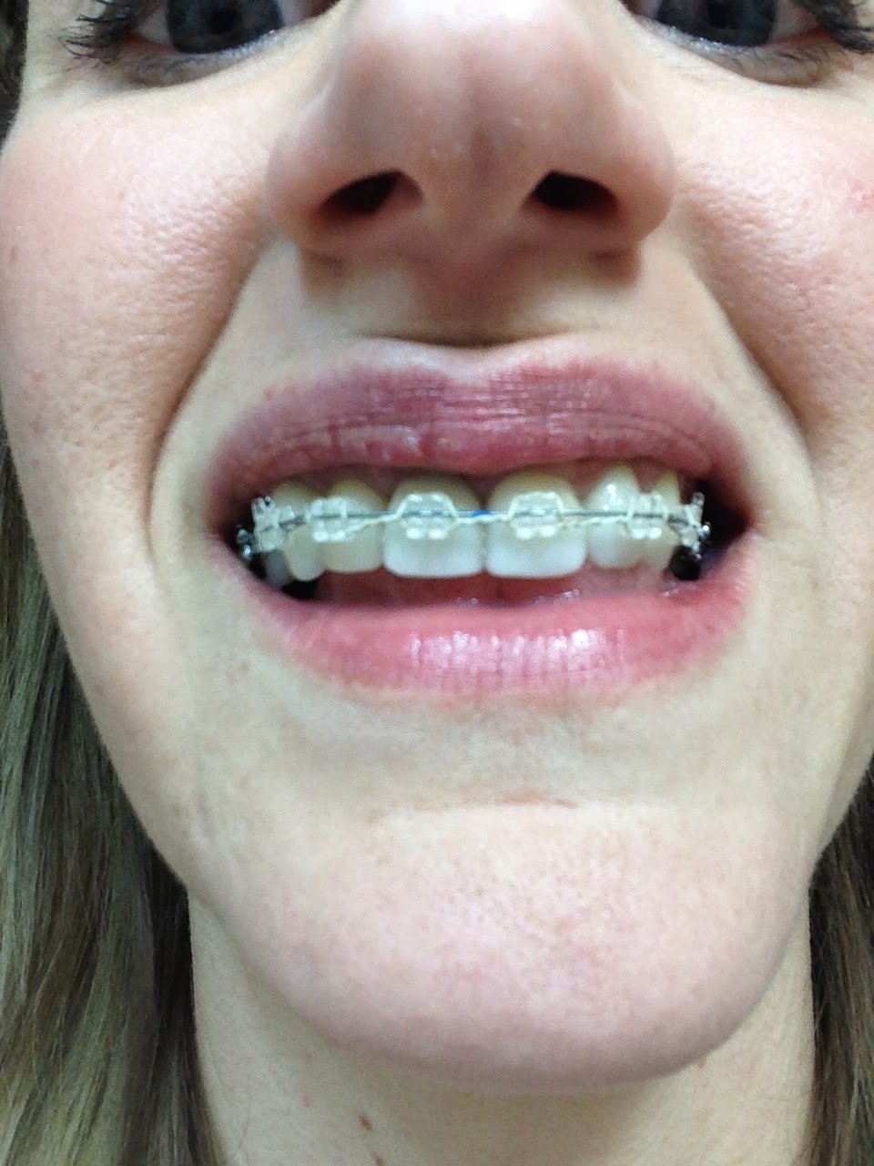 My Broken Jaw Trauma First wire change and no elastics..