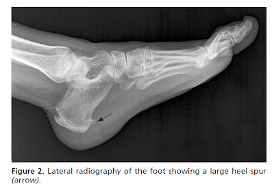 x-ray depicting large heel spur