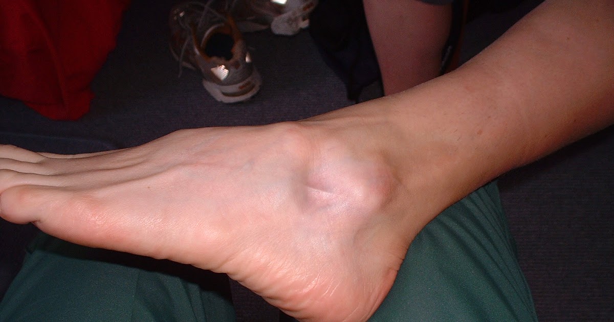 Health, Fitness Naturally! Cortisone Injections