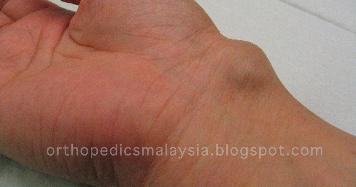 GANGLION CYST swelling in the wrist The Orthopedics Malaysia blog
