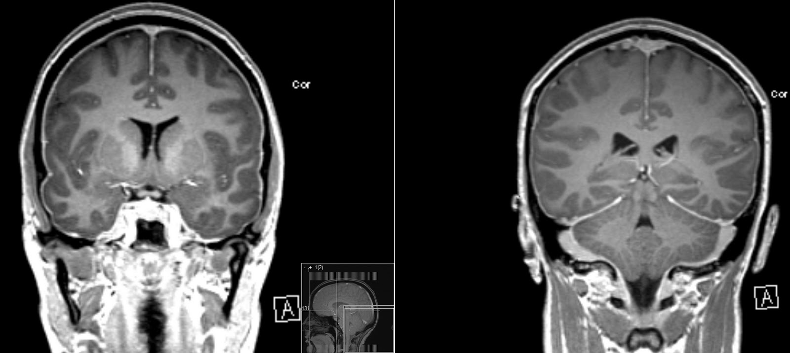 Cerebral Hypotension
