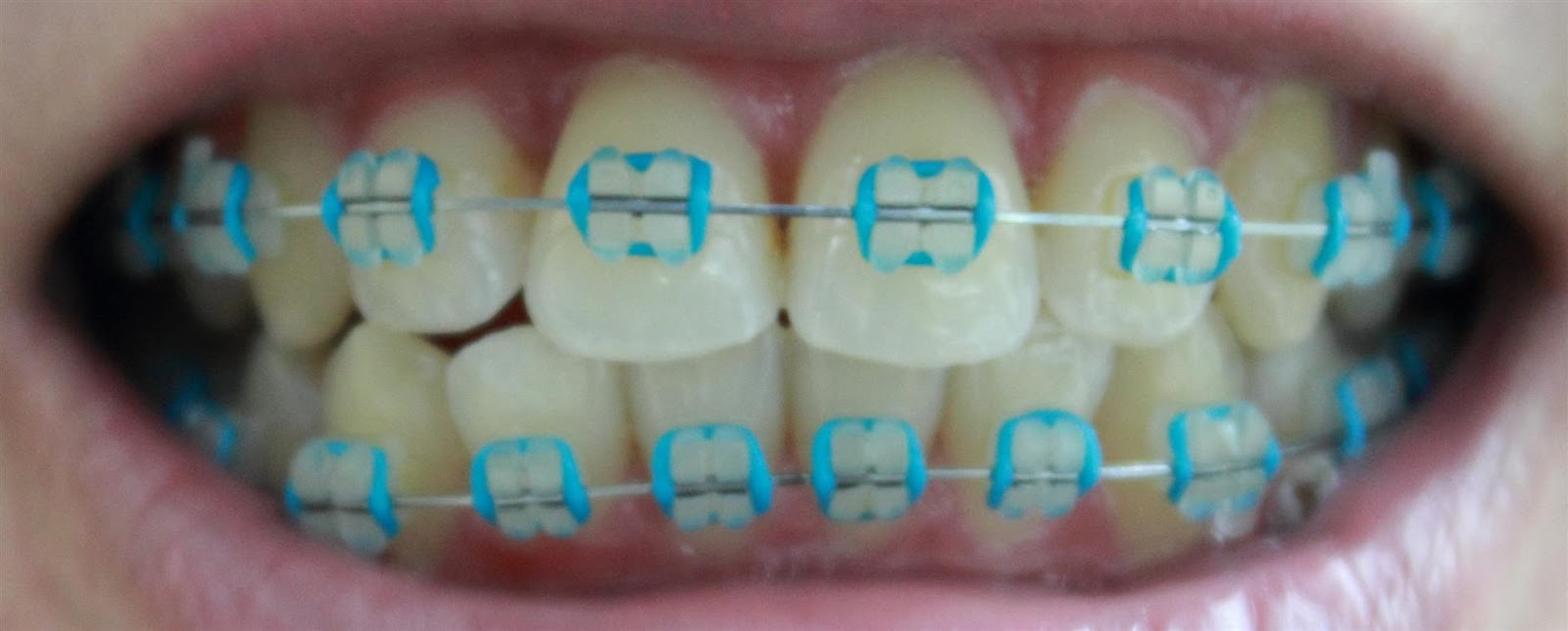 Braces at 25 01 Dec 2012