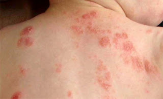 [Image: viem-da-co-dia-di-ung-o-tre.jpg]