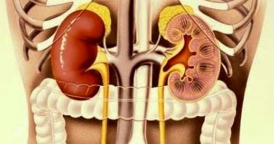 Cara alami menyembuhkan infeksi ginjal ~ Cara Mengobati Penyakit Maag