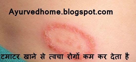 Skin Diseases Controlled with Eating Tomatoes  टमाटर खाने से त्वचा रोगों कम कर देता है  Tamatar Khaane Se Tavcha Roog Door Hote Hai