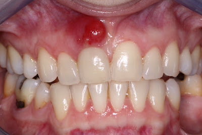 Healthy and Beauty Tips: Tooth Abscess Treatment | Tooth Abscess Relief