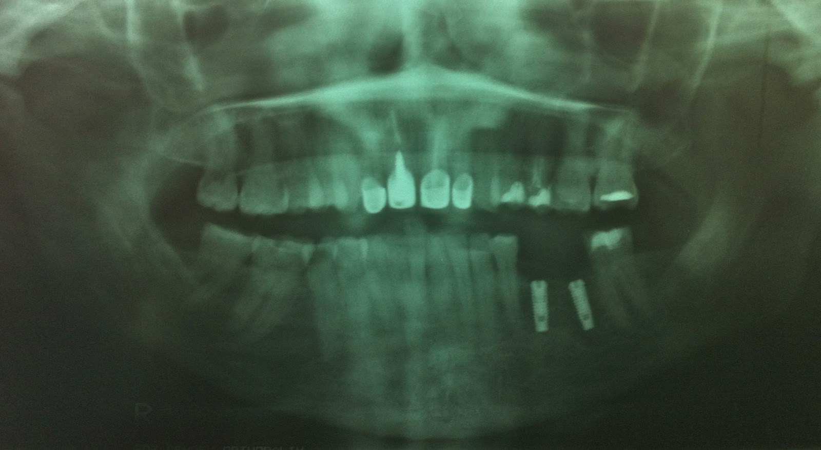 What Type of Xrays do I need for a Dental Implant? Dental Implant