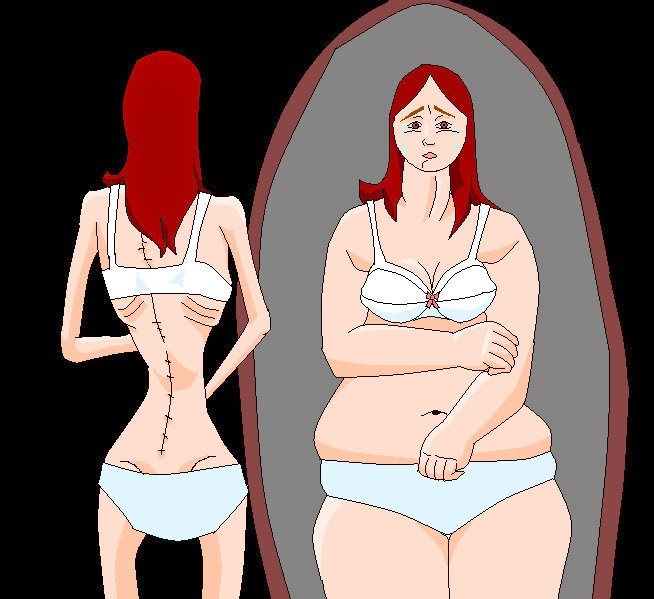 " Anorexia nerviosa" segun los medicos