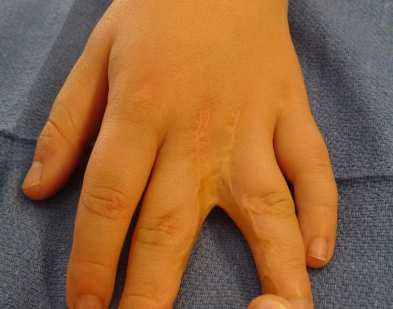  Congenital Hand and Arm Differences