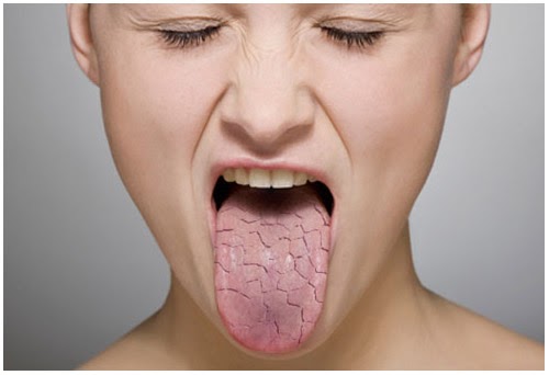 Xerostomia Definition