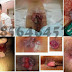Anus atau Dubur Keluar Darah Segar dan Berlendir Gejala Apa thumbnail