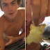 Teen peels giant scab off his arm - Disgusting!