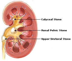 50 ஆயிரம் தேவையில்லை 50 ரூபாய் மட்டும் போதும் சிறுநீரகக்கல்லுக்கு தீர்வு  Kidney+stones+1
