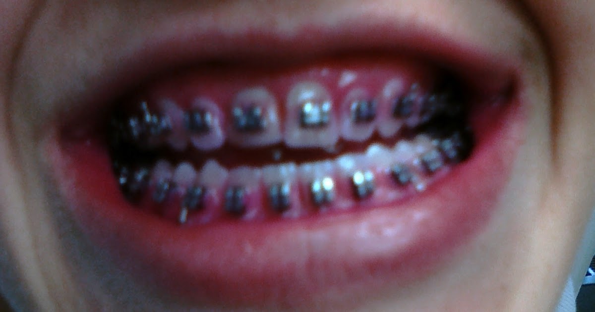 braces brushing