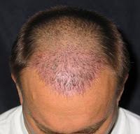 Antiaging Systems Products Nizoral 2 Shampoo For Hair Loss And