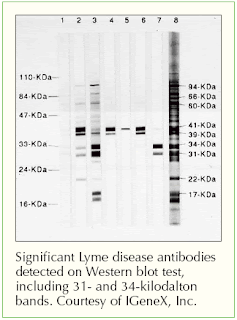 lyme blot bands interpet lymer