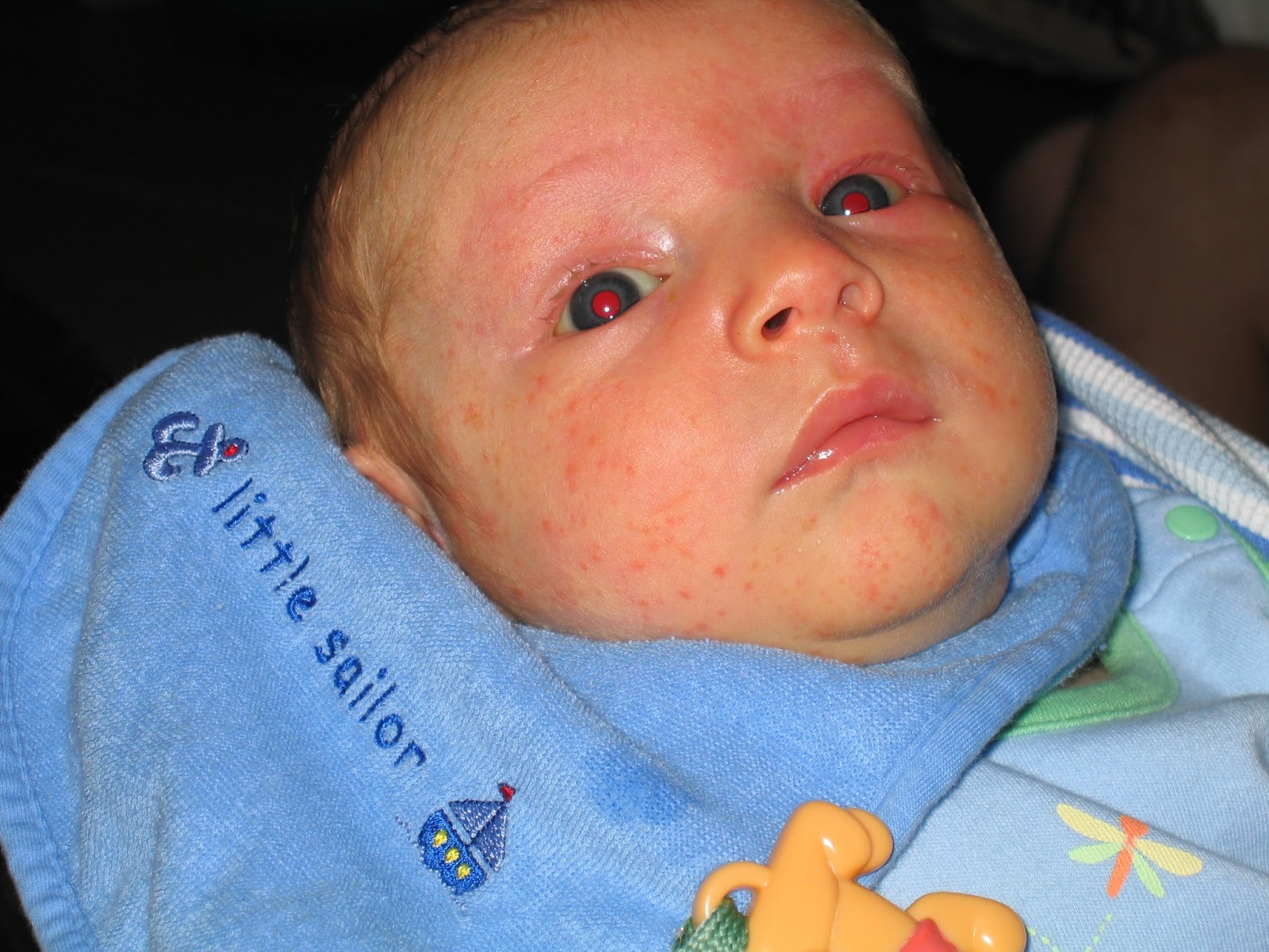 Baby Acne Cure and Treatment Baby Acne Pictures