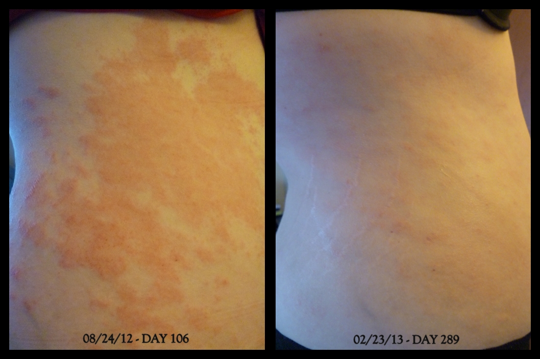 A Little Itchy Day 289 Look Ma, No Rash! (photos)