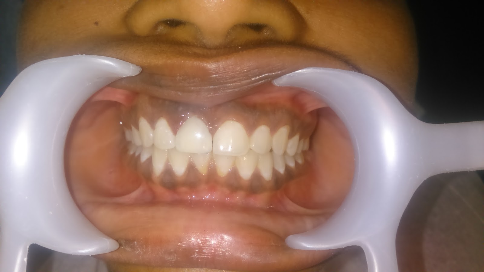 Affordable Dentures And Implants Hyattsville Md - Affordable Dentures® Is Proud To Serve Patients For Implant Dentistry In Hyattsville, Md And The Surrounding Areas.