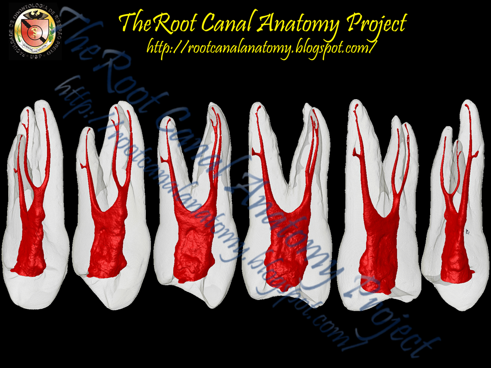 The Root Canal Anatomy Project ThreeRooted Maxillary First Premolar