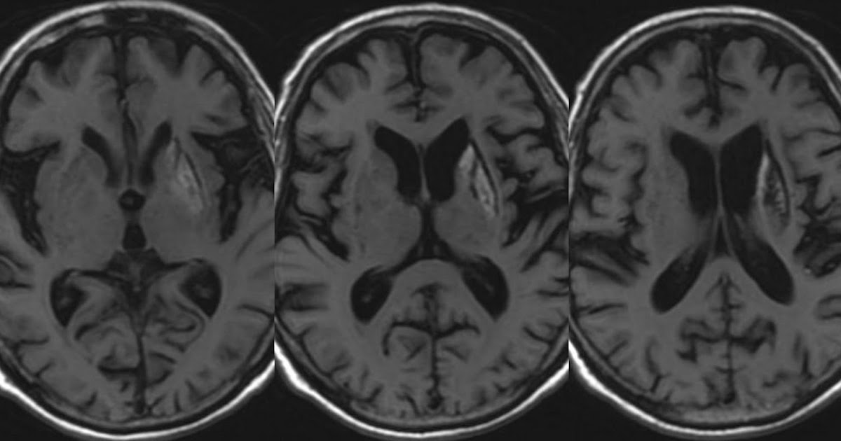 Neuroradiology Cases UL Basal ganglia T1 hyperintensity