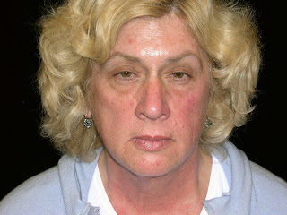 facelift surgery Marin County facelift surgery Marin County