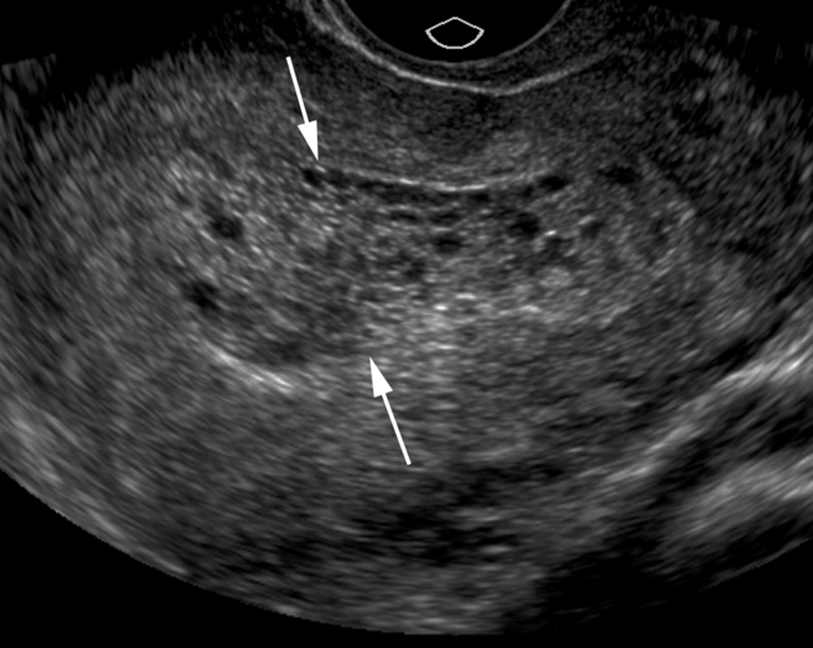 Molar+Pregnancy+Ultrasound complete molar on ultrasound molar with fetus molar pregnancy should