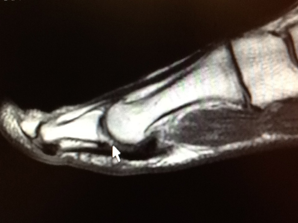 Mri sesamoid foot fracture toe bone problems noted blake ankle richard dr irregularity base another metatarsal Foot and Ankle Problems By Dr. Richard Blake: Sesamoid Fracture Advice