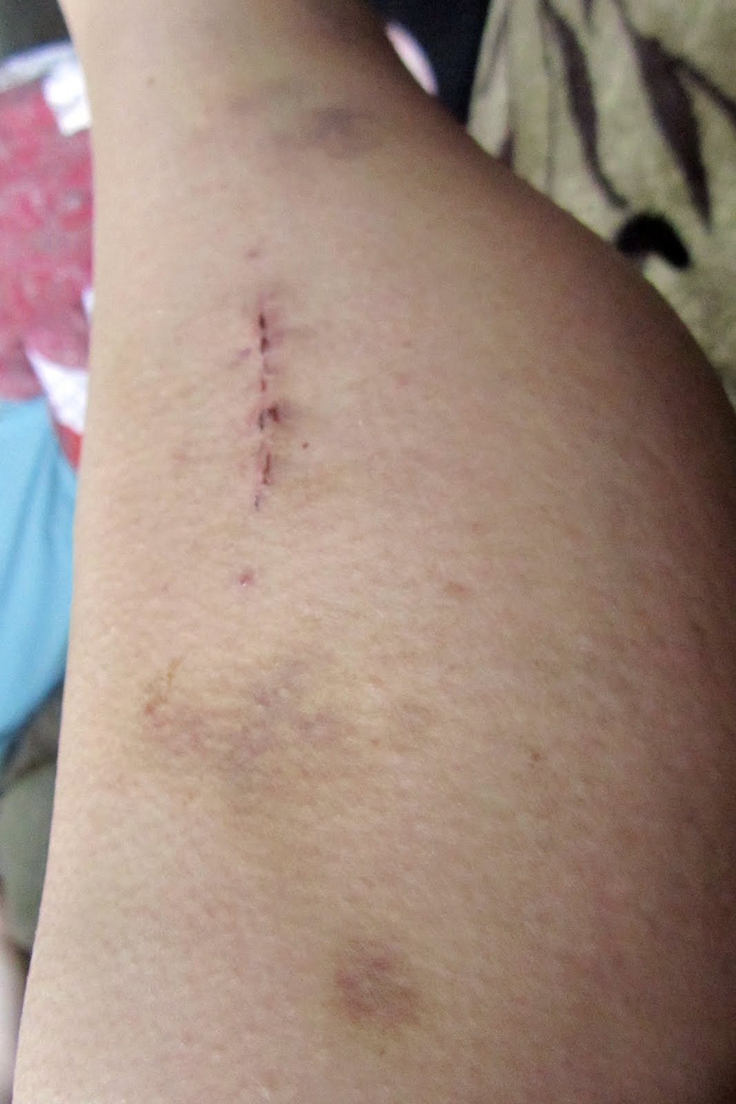 My Experience with Chronic Exertional Compartment Syndrome My Progress