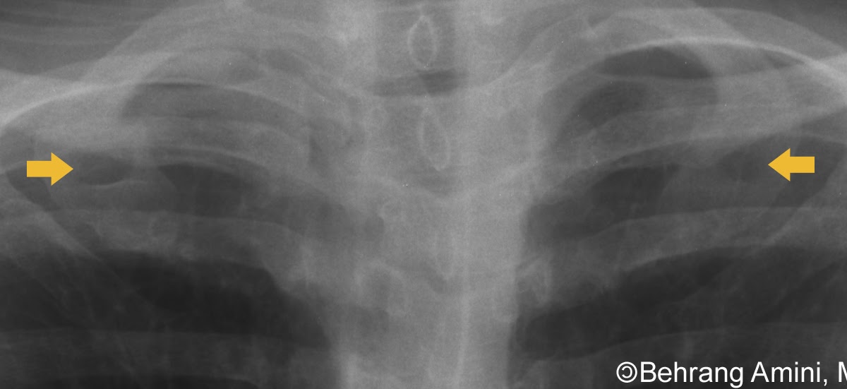 Roentgen Ray Reader Anterior Rib Lucencies