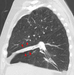atelectasis collapse ct lung scan partial alveoli alveolar causes absorption