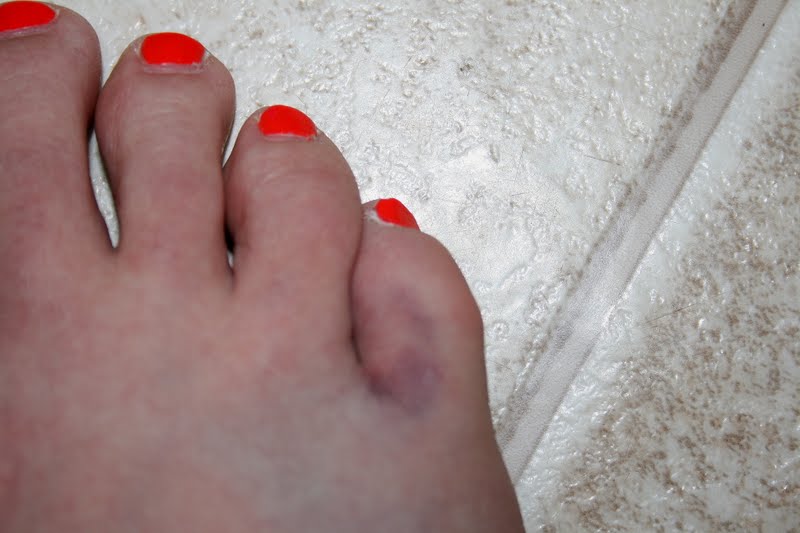 Broken Toe Bruising