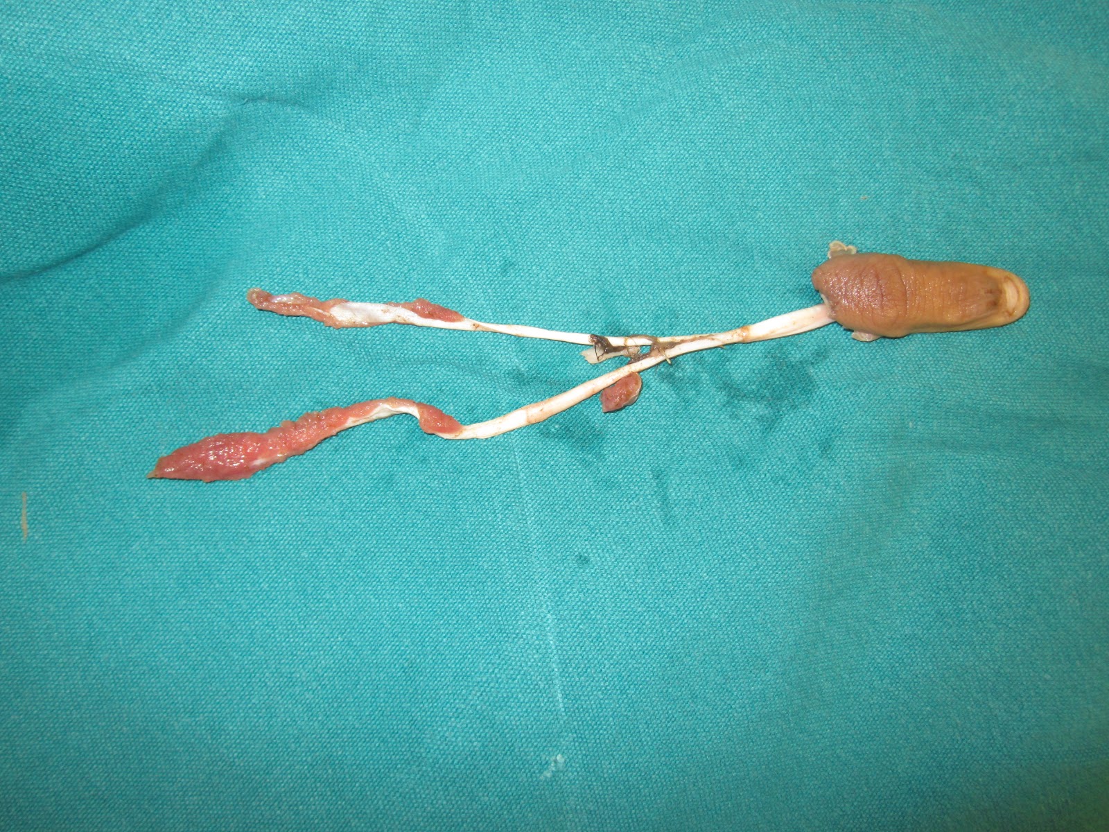 CRUSH INJURIES OF HAND AND UPPER LIMB INJURIES DOG BITE AVULSION