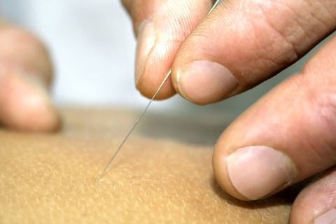 A History Of Acupuncture 