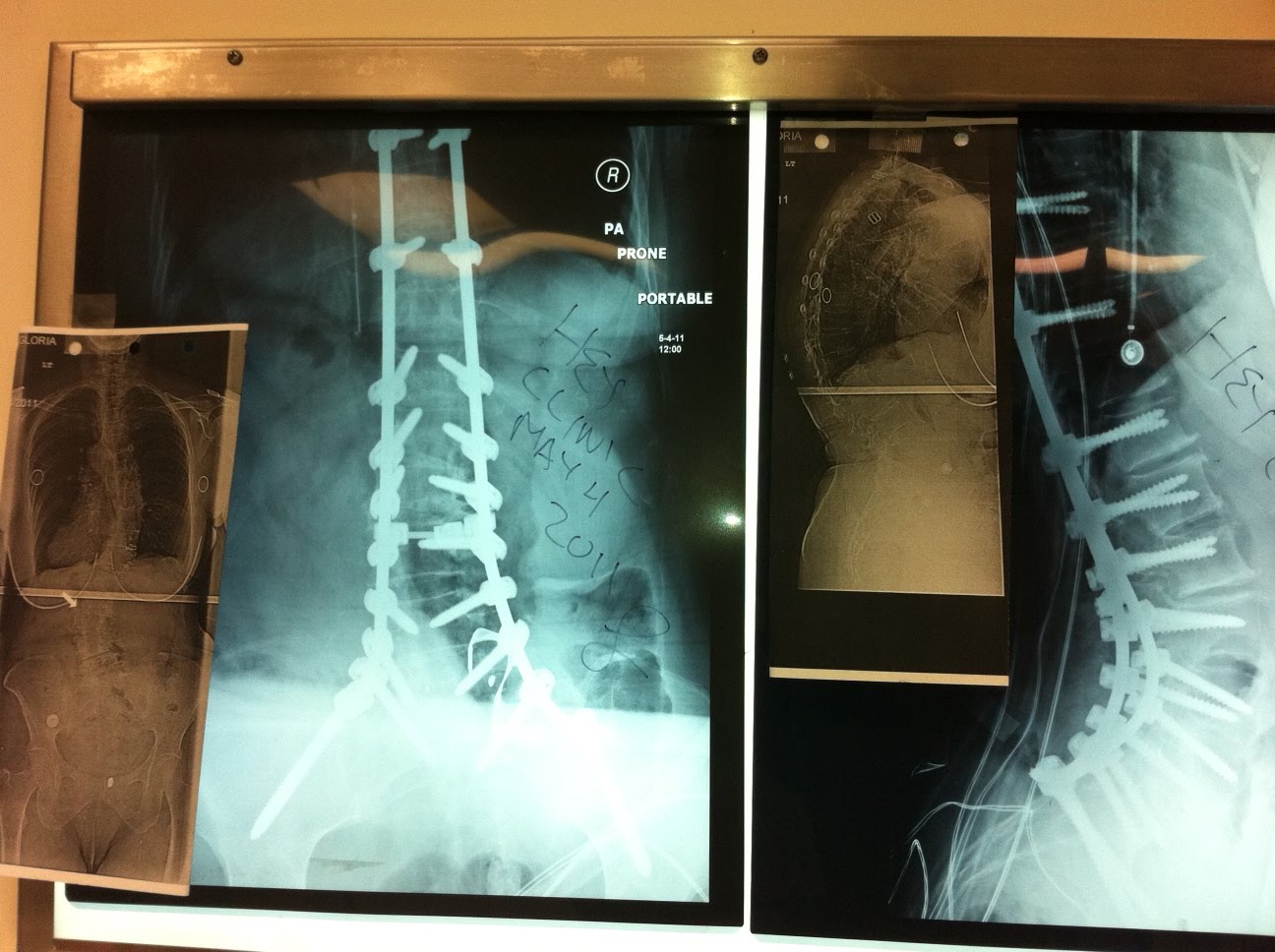 Severe adult kyphoscoliosis and stenosis fixed today Hey Clinic