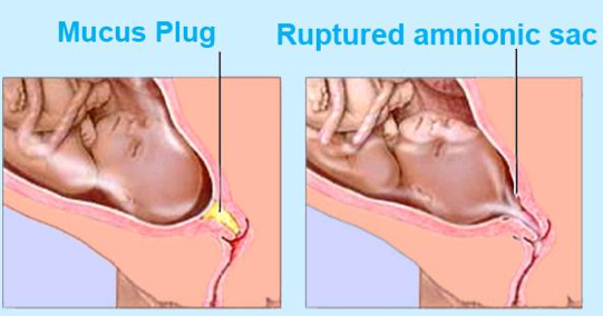 Mucus Plug Pregnancy - Signs of labor | Mommy and Kids