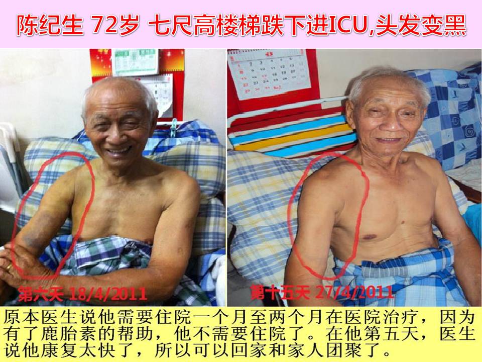 TAN KEE SANG (72 YEARS O) - FALL FROM 7FT HEIGHT LADDER AMITTED INTO ICU, HAIR GROW TO DARKER COLOR