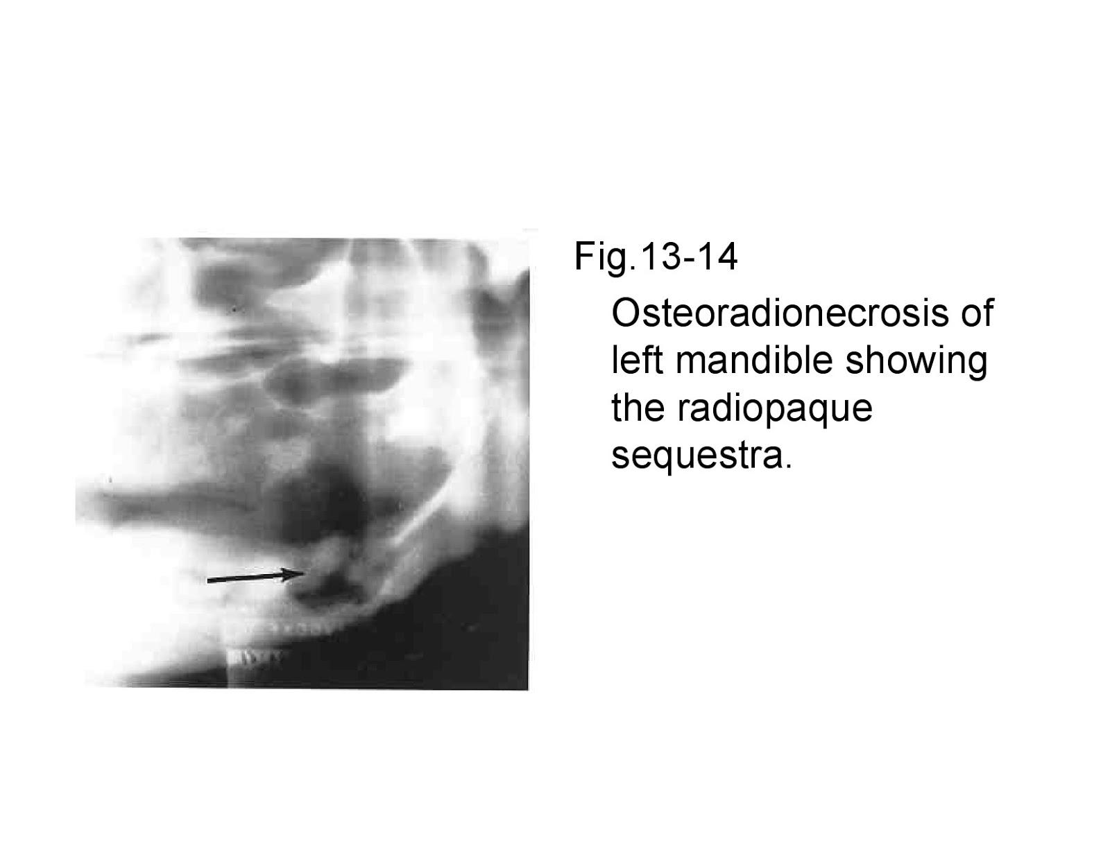 Osteomyelitiswith Radiological features Dentistry and Medicine