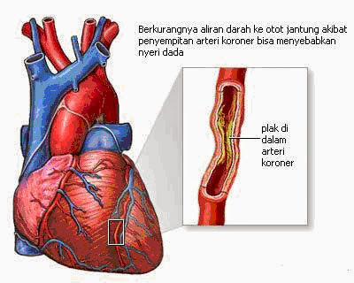 Obat Penyempitan Pembuluh Darah Di Jantung | Obat Pelangsing Herbal