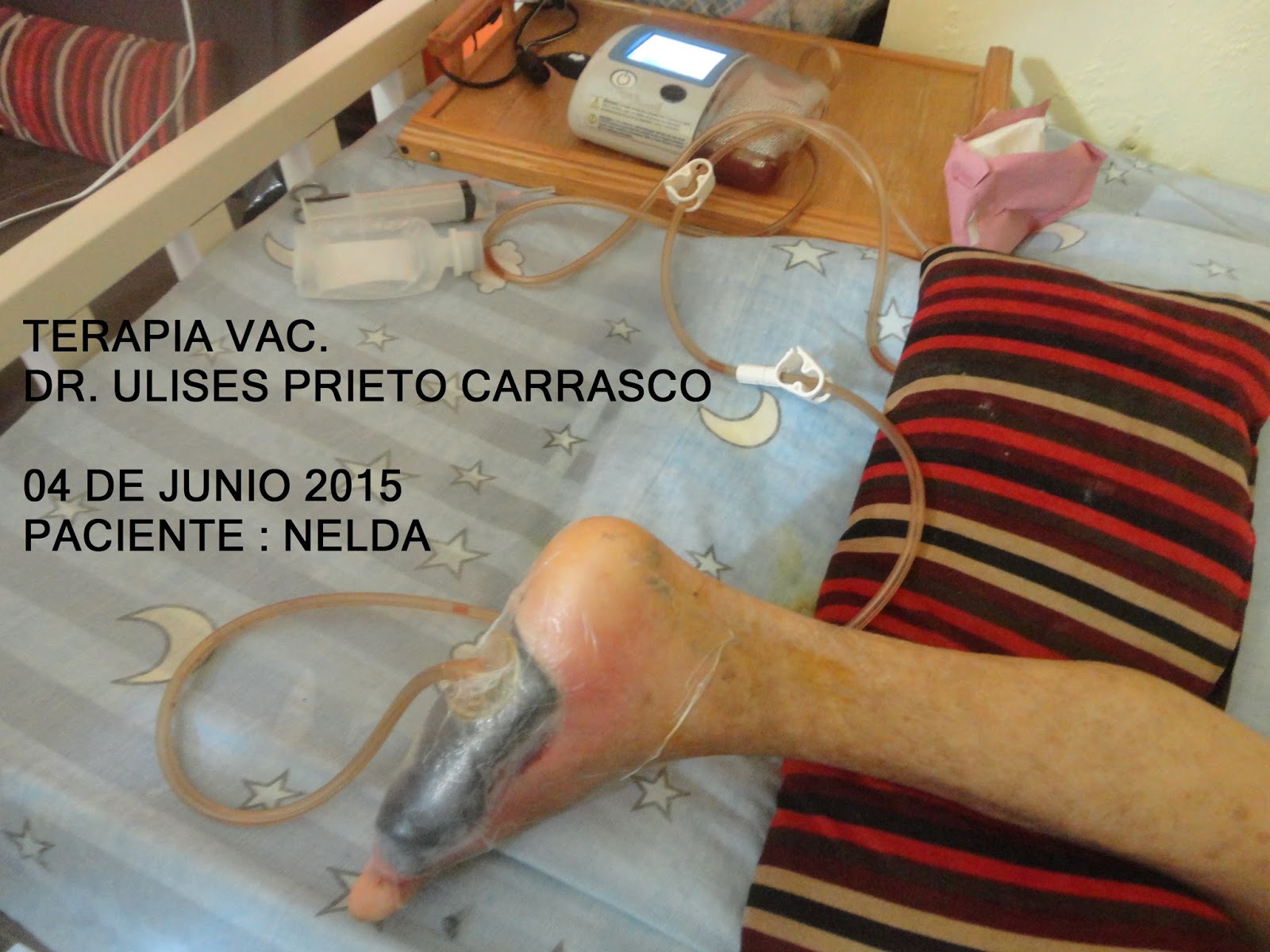 ATENCION ESPECIALIZADA EN PIE DIABETICO CURACIÓN AVANZADA DE PIE