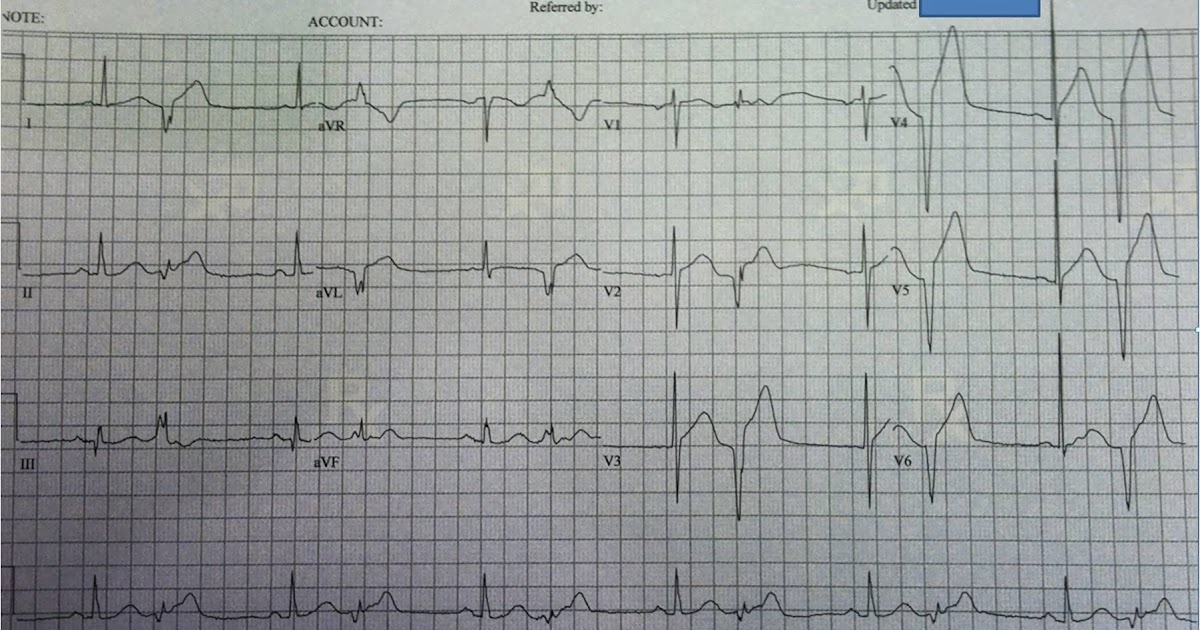 Dr. Smith's ECG Blog Look at the PVCs!!