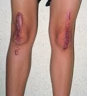 http://obatradangglambung.blogspot.com/2013/11/obat-keloid-alami.html