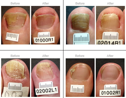 in both fingernails and toenails, nail infection rate is higher