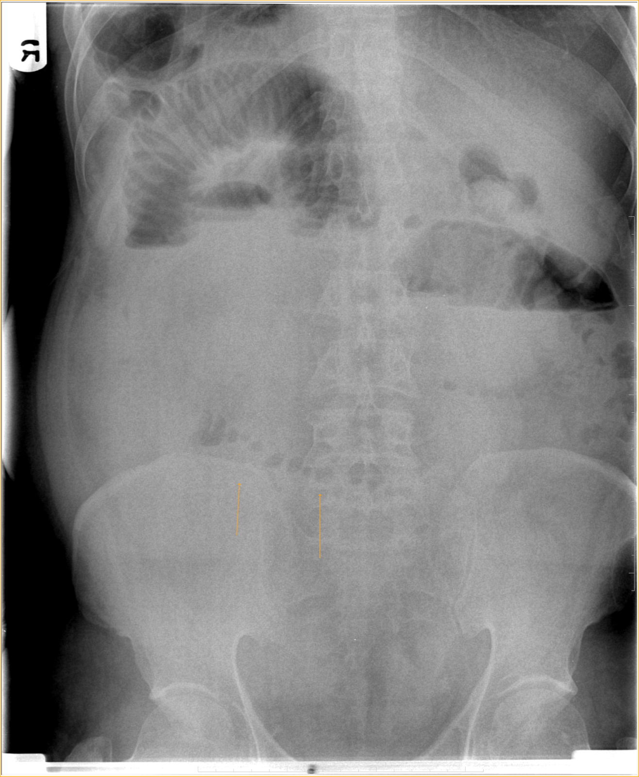 String of Pearls SignIntestinal Obstruction Sumer's Radiology Blog