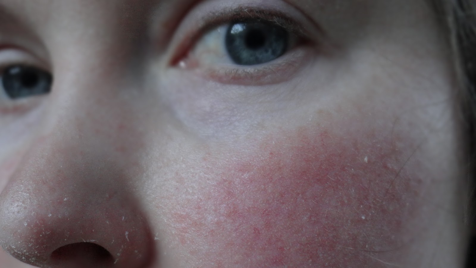 Scarlet Letters, dealing with vascular rosacea and the rest December 2012