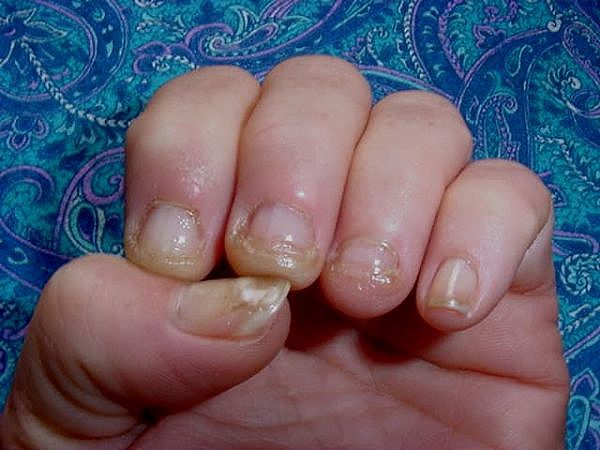increases the risk of developing nail infections during a manicure