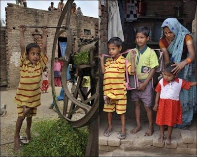 Indian Conjoined Twins pictures