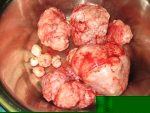 fibroid fibroid