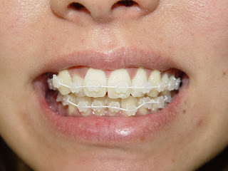 Dra.Carol Dalsoto: Aparelho estético de porcelana